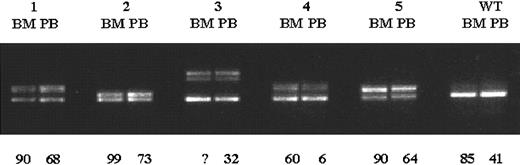 Fig. 2. Comparison of BM and PB samples from FLT3ITD–positive patients. / Exons 14 and 15 of the FLT3 gene were PCR amplified from diagnostic BM and PB specimens from 5 patients with FLT3ITDs, and PCR products were resolved on a 2.5% LMP agarose gel. Percentages of BM and PB blast cells are shown below the gel. Although the proportion of PB blast cells was considerably lower in 4 of 5 patients, BM and PB samples were indistinguishable on LMP gel electrophoresis. WT indicates samples from a patient withoutFLT3 ITD; 1-5, samples from 5 different AML patients withFLT3 ITDs; and ?, the percentage of BM blasts was unknown in the patient.