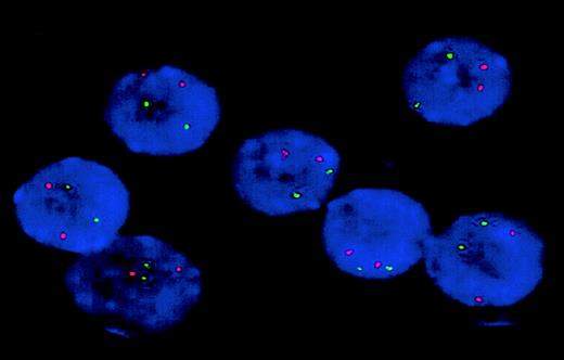 Fig. 3. Analysis of monoallelic FLT3 deletions. / Interphase nuclei from the patient with loss of the wild-type allele were studied by FISH using BAC clone RP11-179F17 (green). Cohybridization with a probe recognizing a genomic region at chromosome band 7q35 (red) was performed to monitor hybridization efficiency. All 7 nuclei exhibit 2 green and 2 red fluorescence signals, indicating that no monoallelic FLT3 deletion occurred in this patient. Identical results were obtained with BAC clone RP11-9D14 (not shown). Original magnification × 100.