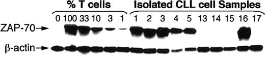 Fig. 2. ZAP-70 protein expression in CLL cell samples that expressed nonmutated (samples 1 through 5) or mutated (samples 13 through 17) immunoglobulin genes. / For immunoblot analyses, 10 μg protein lysate from each sample was loaded onto separate lanes of a polyacrylamide gel. Cell lysates were prepared from highly purified leukemia B cells (greater than 99% purity), Stable transfected Burkitt lymphoma B-cell line (BJAB), or mixtures of BJAB and isolated normal blood T cells containing 100%, 33%, 10%, 3%, or 1% T cells, as indicated at the top of the sample lanes. The immunoblots were probed with anti–ZAP-70 antibody to detect ZAP-70 protein, as indicated by the labeled arrow on the left-hand side of the Figure. The blots were stripped and reprobed with antibodies specific for β-actin, as indicated by the labeled arrow of the bottom row.