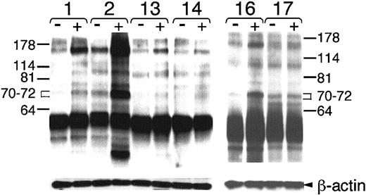 Fig. 3. Immunoblot analysis of tyrosine-phosphorylated proteins in the lysates of CLL cells. / Cell lysates from 5 × 106 cells were loaded onto separate lanes of the polyacrylamide gel for immunoblot analysis with the anti–P-Tyr antibody 4G10. Each cell sample is indicated by a number above the pair of lanes for lysates made from cells before (−) or after (+) BCR stimulation with anti-μ F(ab′)2. Lysates from ZAP-70+ cases CLL1 (1) and CLL2 (2) are compared with those of CLL13 (13) and CLL14 (14) in the left panel. Lysates from samples obtained from monozygous twins, CLL16 (16) and CLL17 (17), but that were discordant for expression of ZAP-70, are provided in the right panel. Molecular weight markers are indicated on the left and right margins. The brackets define the areas between 70 and 72 kDa in size that were scanned for density with NIH image software. The blots were stripped and then probed with anti–β-actin to monitor for uniformity of protein loading (bottom row labeled “β-actin” on the right-hand margin).