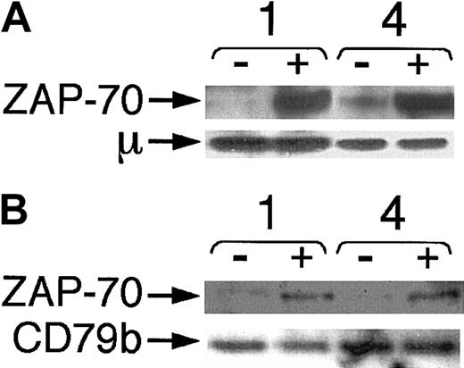 Fig. 6. Association of ZAP-70 with IgM and CD79b in CLL B cells after BCR ligation. / Lysates were made before and 10 minutes after BCR ligation with anti-μ F(ab′)2 and prepared for immune precipitation with antibodies specific for human IgM (A) or CD79b (B). Samples were loaded onto separate lanes of a polyacrylamide gel for immunoblot analysis with anti–ZAP-70, as indicated by the labeled arrow marked “ZAP-70.” Stripped blots were reprobed for anti-μ (A) or anti-CD79b (B), as indicated by the arrows marked “μ” or “CD79b,” respectively. Each pair of lanes represents the lysates prepared from cells before (−) or after (+) BCR ligation, as indicated at the top of each sample lane. The numbers of the CLL samples are provided above each pair of lanes.