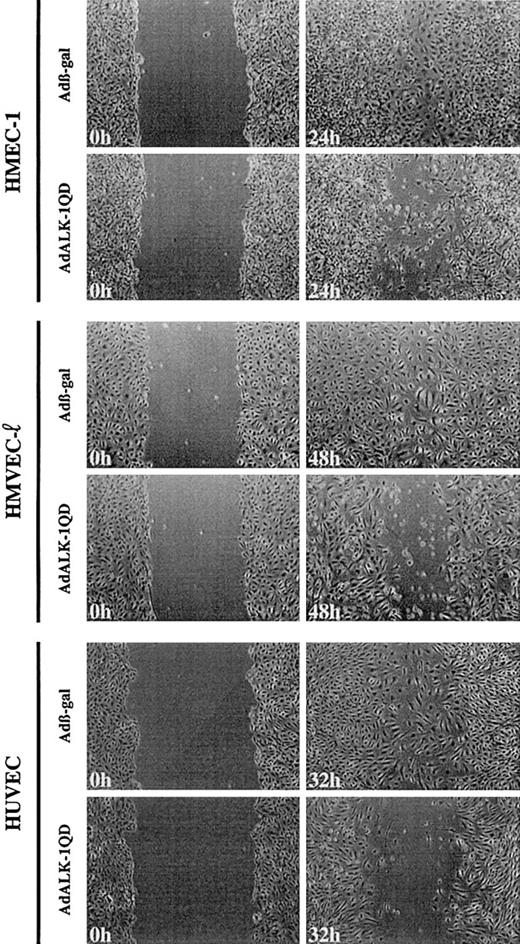 Fig. 4. ALK-1QD inhibits HMEC-1, HMVEC-l, and HUVEC migration in a wound assay. / These endothelial cells were infected for 15 hours with AdALK-1QD or Adβ-gal (MOI = 50). At 15 hours after infection, the cell monolayer was scratched to create a wound. The cells were observed by phase contrast microscopy and photographed at time 0 (wounding) and when the wound was closed in Adβ-gal–infected cells (24 hours for HMEC-1's, 48 hours for HMVEC-l's, and 32 hours for HUVECs). Original magnifications, × 50.