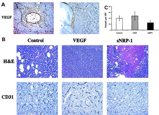 Fig. 4. Opposite effects of VEGF and sNRP-1 on chloroma neovascularization. / (A) In vivo secretion of VEGF. Tumors from mice injected with encapsulated NMuMG/VEGF cells were harvested after 21 days and processed for histologic examination. Tissue sections were stained with anti–human VEGF antibodies and photographed under × 100 (left) and × 400 (right) original magnification. A cross-sectioned capsule and surrounding tumor tissue is shown. Some VEGF-positive stained cells can be seen within the capsule. (B) Tumor neovascularization. Tumors from NMuMG (control), NMuMG/VEGF (VEGF), and NMuMG/sNRP-1 (sNRP-1) groups, as indicated, were harvested and processed for histologic examination. Tumor sections were stained with H&E (top panels) and with anti–mouse CD31 antibodies (bottom panels) and photographed under × 400. (C) Microvessel density (MVD) was determined by counting 10 high-power fields (HPFs) from the CD31 stained sections in panel B. The numbers represent the MVD average, and standard deviations were calculated.