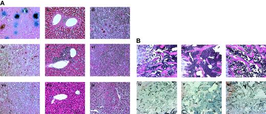 Fig. 5. Soluble NRP-1 inhibits liver, spleen, and bone infiltration of leukemic cells. / M1 cells (2 × 106 cells per mouse) were injected intravenously into SCID mice. After 7 days, adenoviral vectors encoding for Fc-sNRP-1 (Avii-ix and Biii-iv), VEGF (Aiv,vi and Bii,v), and lacZ (Ai-iii and Bi,iv) were injected intravenously, as described in “Materials and methods.” On day 28, 2 mice from each group were killed and their bones, livers, and spleens were processed for histologic examination. (A) Liver tissues were processed for LacZ staining (Ai,iv,vii), as described in “Materials and methods.” Liver and spleen tissues were also stained with H&E (ii,v,viii and iii,vi,ix, respectively). Stained sections were examined microscopically and representative images were recorded (original magnification × 200). (B) Bone sections were stained with H&E (i-iii) and with anti–mouse CD31 antibodies (iv-vi). Stained sections were examined microscopically and representative images were recorded (original magnification × 200).