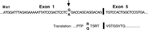 Fig. 1. Structure and sequence of a Pax5 mRNA isoform that was missing exons 2, 3, and 4 and was detected in the plasma cells of an MM patient in a RAP analysis. / Structure and sequence of the exon junctions as observed in the plasma cells of MM patient P1. Arrows indicate a nucleotide position at which P1 appeared to be heterozygous.