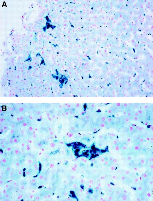 Fig. 1. Liver histology (Perls stain). / Liver biopsy for the proband's sister showing iron staining predominantly in Kupffer cells. (A) Low power; (B) high power.