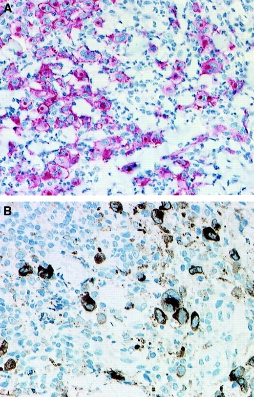 Fig. 1. CD30 and granzyme B expression. / Immunohistologic detection of CD30 expression (A; immunoalkaline phosphatase–antiphosphatase staining) and granzyme B expression (B; streptavidin-biotin staining) in 2 cases of LyP. (A) Patient no. 8; (B) patient no 4. (Original magnification × 130.)
