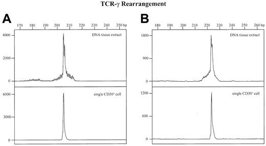 Fig. 3. Detection of TCR-γ rearrangements by PCR and GeneScan analysis in whole tissue DNA extracts and single CD30+cells. / The x-axes represent molecular size (base pairs) and the y-axes fluorescence intensity. (A) Whole-tissue DNA extract (upper panel) and corresponding CD30+ single cell (lower panel) of patient no. 1. (B) Whole tissue DNA extract (upper panel) and corresponding CD30+ single cell (lower panel) of patient no. 5.