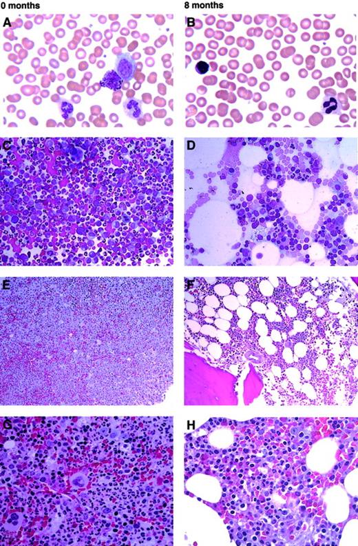 Fig. 1. Typical morphologic findings in PB and marrow of a CML patient prior to treatment and after 8 months on imatinib mesylate. / (A) The pretreatment PB smear shows leukocytosis with circulating granulocytic precursors and basophilia, typical of chronic-phase CML (WBC count, 38.7 × 109/L; platelet count, 207 × 109/L). (B) After 8 months of imatinib mesylate treatment, the PB shows adequate counts and normal morphology (WBC count, 3.5 × 109/L; platelet count, 148 × 109/L). (C) The pretreatment bone marrow aspirate is hypercellular, with marked myeloid hyperplasia and M/E ratio exceeding 10:1. (D) The bone marrow aspirate at 8 months is mildly hypocellular with an M/E ratio of 1:1 owing to decreased myeloid precursors and a relative increase in erythroid precursors. Histiocytes are mildly increased. (E,G) Pretreatment bone marrow biopsy with hypercellularity (more than 95%) and marked myeloid and megakaryocytic hyperplasia, typical of chronic phase CML. (F,H) At 8 months, the biopsy shows borderline hypocellularity (30% to 40%) with mildly decreased myeloid and relatively increased erythroid precursors. Panels A, B show original magnification × 600; panels C, D, × 400; panels E, F, × 200; panels G, H, × 600. Panels A-D are Wright-Giemsa–stained; panels E-H are hematoxylin and eosin–stained.