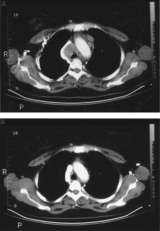 Fig. 1. CT scans from patient 1. / (A) Chest CT scan images before treatment. (B) Chest CT scan images at 8 weeks after treatment shows resolution of adenopathy.