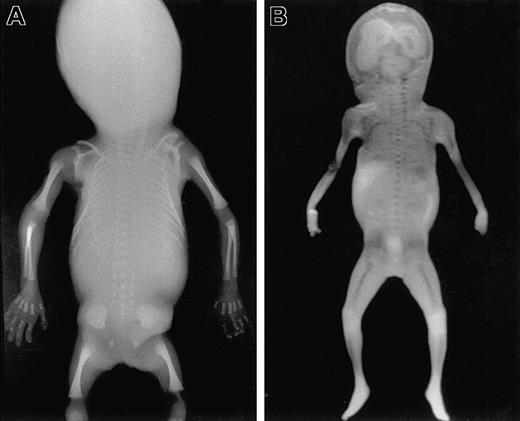 Fig. 1. Total body radiography and coronal MRI. / Total body anteroposterior radiograph image (A) and T1-weighted coronal scout MRI (B) of a fetus 21 weeks of gestational age. Areas of ossification containing BM are clearly recognizable as radiodense structures in the radiograph. Corresponding areas of low signal intensity (dark) are visible in the MRI. These areas are well delineated from the surrounding cartilage, which shows much higher signal intensity (light).