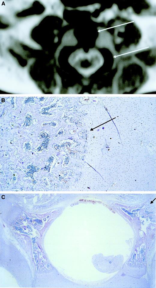 Fig. 3. Ossification center. / MRI shows low signal intensity (black) in the central area of the vertebral body corresponding to an ossification center (upper arrow). Low signal intensity corresponding to an ossification center is also visible in the lateral area of the vertebral pedicles (lower arrow) (A). Microscopic transversal sections (4 μm) stained with hematoxylin-eosin of the central area of the vertebral body (B) and the lateral areas of the vertebral pedicles (C) show hematopoietic cells between the spiculae, indicating that the low-intensity areas visualized by MRI are hematopoietic areas. The upper and lower arrows in panel A correspond with the arrows in panels B and C, respectively. Original magnification × 40.