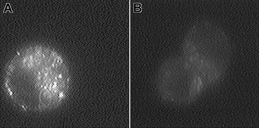 Fig. 2. Fluorescence micrographs of KG-1 cells treated with calcein-containing liposomes. / KG-1 cells were incubated with f-L-calcein (A) or L-calcein (B) for 1 hour at 37°C and were washed 3 times with cold PBS. Images of the live cells were collected with a digital imaging system, as described in “Materials and methods.” Magnification, × 2000.