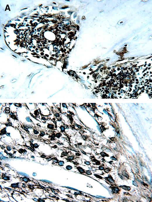 Fig. 10. Staining for kappa light chain identifies human tumor cells in contralateral bone fragments of a mouse injected with soluble syndecan-1–expressing cells. / To determine if tumor cells had disseminated from the bone that was injected with tumor, the noninjected contralateral bone was harvested at the time of animal killing and processed for immunohistochemistry by using anti-kappa light chain antibodies. Stained tumor cells are clearly localized within the bone at both (A) low (× 200) and (B) high (× 400) magnification.
