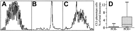 Fig. 3. Confirmation of monoclonality by fluorescent IgH-PCR analysis. / The detection of monoclonality by IgH-PCR analysis of 3 representative individuals is shown. DNA from samples containing CLL phenotype cells and from age- and sex-matched normal controls (2 controls per individual with CLL phenotype cells) was amplified using a fluorescent JH primer and consensus primers to framework VH regions. PCR products show a range of sizes with a normal distribution separated by 3 base pairs in normal individuals (A), a single peak in individuals whose B lymphocytes are all CLL phenotype (B), or a large single peak on an otherwise normal distribution in individuals with both CLL phenotype and polyclonal B lymphocytes (C). PCR results for patients with CLL-phenotype cells detectable by flow cytometry are shown (D). The flow assay is more sensitive than PCR detection20 and as such, IgH-PCR analysis rarely identified a monoclonal population in samples with low levels (< 0.5%) of CLL phenotype cells (D).