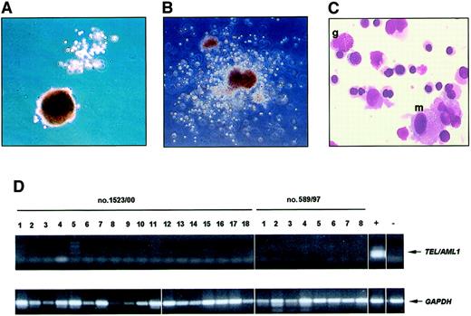 Fig. 4. Analysis of multilineage colonies from flow-sorted CD34+CD19− cells. / The upper left photos show a CFU-G together with a BFU-E (A) and a multilineage CFU-GEMM (B) in methylcellulose cultures initiated with purified CD34+CD19− cells from patient nos. 589/97 (A) and 1523/00 (B). A Pappenheim-stained smear of the CFU-GEMM shows the presence of granulocytic (g), macrophage (m), and erythroid cells (C). Original magnification A-B, × 50; C, × 1000. A representative RT-PCR analysis of 18 colonies from patient no. 1523/00 and 8 colonies from patient no. 589/97 shows that CFU derived from sorted CD34+CD19− cells lack expression of TEL/AML1 (D).