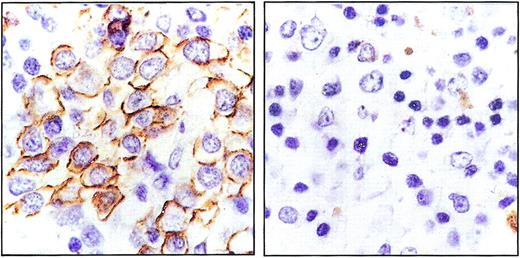 Fig. 4. Partial remissions in bone marrow and spleen. / Spleen sections of OF-engrafted mice treated with anti-SK CTLs (left) or anti-OF CTLs (right). Sections were stained with hematoxylin-eosin and immunostained with peroxidase-linked antihuman CD20. Original magnification × 600.