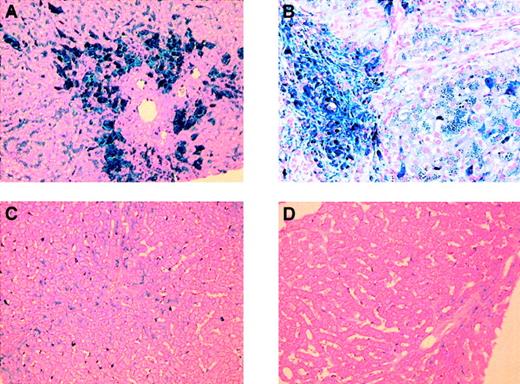 Fig. 1. Liver biopsy sections from affected family members stained with Perls Prussian blue. / (A) Proband, showing grade 4 iron accumulation at age 56 years. (B) Brother of the proband, showing grade 4 iron accumulation at age 73 years. (C) Son of the proband, showing grade 3 iron accumulation at age 20 years. (D) Daughter of the proband, showing grade 2 iron accumulation at age 19 years. In all patients, iron is prominent in Kupffer cells and macrophages. Iron overload is greater in the older patients, suggesting that iron accumulation is progressive with age. Original magnification × 100.