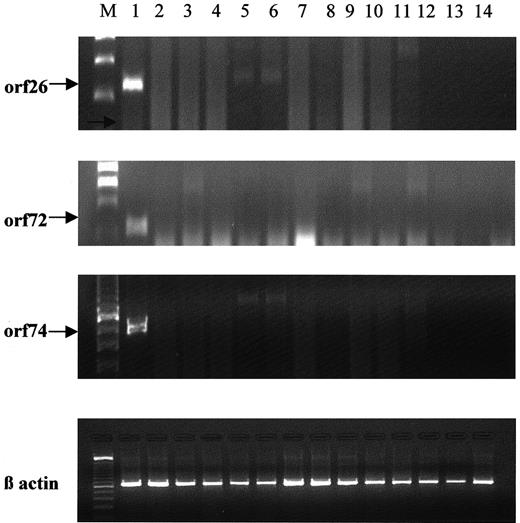 Fig. 1. RT-PCR analyses of KSHV gene expression. / RNA was extracted from LT-BMSCs from 23 patients with MM and 5 healthy donors, and ORF26, 72, and 74 regions of the KSHV genome were amplified. Representative results are shown. Lane 1, the positive control, included RNA from the KSHV-infected BCBL-1 cell line. Lanes 2 to 11 represent RNA from MM patient LT-BMSCs, and lanes 12 to 14 contained RNA from healthy donors.