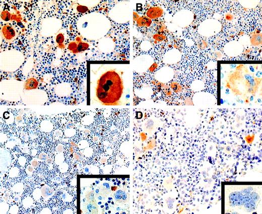 Fig. 1. Expression of c-mpl in essential thrombocythemia. / (A) All megakaryocytes show a uniform, strong staining intensity (× 320). The inset shows a higher magnification of a strongly stained megakaryocyte (× 1000). (B) Heterogeneous pattern of c-mplexpression with coexistence of strongly positive megakaryocytes and a significant percentage of megakaryocytes showing a moderate staining intensity (× 250). Some strongly stained plasma cells are also present. The inset shows a higher magnification of a moderately stained megakaryocyte (× 1000). (C) Heterogeneous pattern of c-mplstaining with moderately positive megakaryocytes together with several weakly stained megakaryocytes (× 250). Several plasma cells show strong c-mpl positivity. The inset shows a higher magnification of a cluster of weakly stained megakaryocytes (× 1000). (D) Heterogeneous pattern of c-mpl expression characterized by the presence of several c-mpl–negative megakaryocytes together with some moderately stained megakaryocytes and a few strongly stained plasma cells (× 250). The inset shows a higher magnification of a c-mpl–negative megakaryocyte (× 1000) (avidin-biotin-peroxidase–complex method in paraffin section lightly counterstained with hematoxylin).