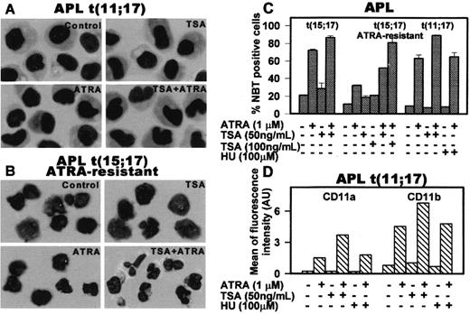 Fig. 1. In vitro effect of ATRA, TSA, and HU in various combinations on t(11;17) APL (patient's blasts), t(15;17) primary APL, and ATRA-resistant t(15;17) APL. / Primary blasts from patient's bone marrow at leukemia relapse, from an ATRA-resistant t(15;17) APL patient and from a t(15;17) APL patient at diagnosis were cultured (1.5 to 2 × 106 cells/mL) in RPMI 1640 medium supplemented with 10% fetal calf serum (FCS) and treated with 1 μM ATRA and/or 100 ng/mL TSA for 5 days as described.12 Differentiation of these blasts was evaluated by morphology in Wright-Giemsa–stained cytospins (panels A and B). Original magnifications, × 40. Differentiation was quantified by the nitroblue tetrazolium (NBT) dye reduction assay (panel C) after treatment of blasts with the indicated agents for 5 days in culture. Results are expressed as the average values of the percentages of positive cells evaluated in at least 10 microscopic fields ± SD. (D) Quantitative fluorescence activated cell sorting (FACS) analysis of the differentiation antigen CD11a and CD11b in APL t(11;17) blasts induced by 4 days of treatment with 1 μM ATRA and/or 50 ng/mL TSA.