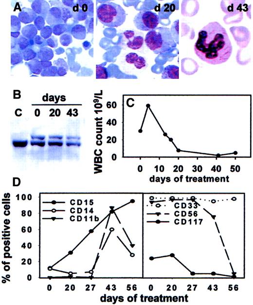 Fig. 2. In vivo response of t(11;17)-AML-M3 to combined treatment with ATRA and hydroxyurea. / (A) Wright-Giemsa staining of bone marrow leukemic cells collected at the indicated days of treatment (day 0, 20, 43). A neutrophilic granulocyte displays several Auer rods in the cytosol, indicating its descent from differentiated leukemia blasts. Original magnifications, × 40. (B) Southern blot analysis of the RARα second intron in leukemia blasts pretreatment (day 0), maturing marrow cells collected at day 20, and neutrophils obtained from day 43 bone marrow buffy coat. The germline 19 kilobase (kb) band observed in normal placental DNA (lane C) and in all other lanes is indicated by the bar. An upper band is also visible in marrow DNAs obtained at day 0, 20, and 43, corresponding to the rearranged RARα allele. (C) Time course of peripheral blood leucocytes during treatment. (D) Sequential immunophenotypic study of bone marrow mononuclear cells as determined by FACS analysis. Increase of CD15 staining cells at day 20 was followed by augment of CD11b and CD14-positive elements (day 43) coupled to decrease of CD117 and CD56 staining cells (days 43 and 56).