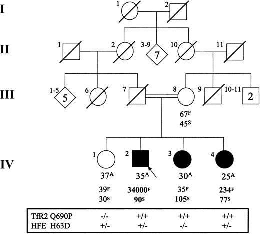 Fig. 2. Q690P pedigree. / Age (A, years), ferritin (F, μg/L), transferrin saturation (S, %), and TfR2 Q690P and HFE H63D mutation status for the Portuguese family. “+” indicates the presence of the mutant allele, and “−” indicates its absence. The mother was heterozygous for both TfR2 Q690P and HFE H63D. Abnormal results are indicated in bold type. Values listed are those of the initial assessment for each patient.