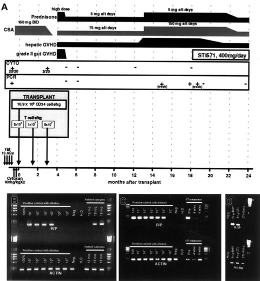 Fig. 1. Transplantation regimen and posttransplantation course. / (A) A schematic representing the SCT regimen, and posttransplantation course, detailing GVHD, immunosuppression, disease status (by both cytogenetics and RT-PCR), and STI571 treatment. (B,C) Results of RT-PCR for RAB5EP-PDGFBR (R-P) and actin control transcripts. Pretransplantation bone marrow mRNA was diluted in negative control mRNA for semiquantitative purposes. In panel B, the patient's test samples are labeled by time from transplantation (12-18 months); in panel C the patient samples are labeled by time from initiating STI571 therapy (pre, immediately before initiating therapy). (D) Results of RT-PCR for RAB5EP-PDGFBR (R-P) and actin control transcripts, 6 months after initiation of STI571 therapy compared to pretransplantation and pre-STI571 time points.