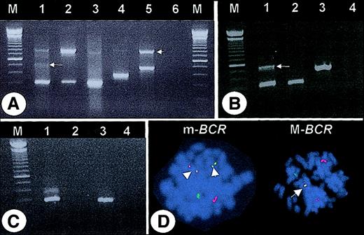 Fig. 1. PCR amplification from cDNA and FISH. / (A) Multiplex PCR. Lane 1 = case #1, lane 2 = case #2, lane 3 = e13a2-positive patient, lane 4 = K562 cell line (e14a2 positive), lane 5 = SD1 cell line (e1a2 positive), lane 6 = “blank.” Note the faint band of approximately 500 bp (arrow) and the 800-bp band corresponding to BCR(arrowhead). (B) PCR with primers corresponding to BCR exon e1 and ABL exon a3. Lane 1 = case #1, lane 2 = case #2, lane 3 = SD1 cell line, lane 4 = “blank.” Sequencing of the 540-bp PCR product (arrow) revealed 51 bp ofBCR intron 1 (nt 75253-75302, accession U07000) fused between e1 and a3. (C) PCR with primers corresponding to BCRexon e1 and ABL exon a2. Lane 1 = case #1, lane 2 = case #2, lane 3 = SD1 cell line, lane 4 = “blank.” M indicates molecular weight marker. (D) FISH (LSI bcr/abl probe, Vysis, Downer's Grove, IL). Left panel (case #1): two yellow fusion signals (arrowheads) indicate an m-BCR rearrangement. Right panel: one yellow fusion signal (arrow) indicates an M-BCRrearrangement (patient with confirmed e13a2 transcript).
