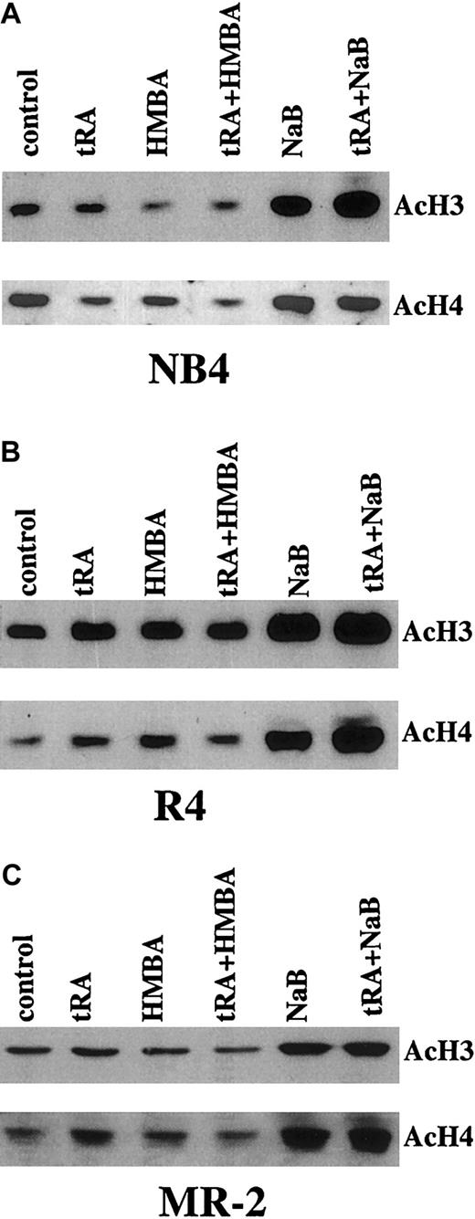 Fig. 3. Western blot analysis of AcH3 and AcH4 in NB4 and R4 cells treated with tRA combined with HMBA or NaB. / The cells were treated with 10−7 μM tRA, 2 mM HMBA, and 0.5 mM NaB, alone or in combination as labeled, for 3 days. AcH3 and AcH4 were isolated and detected as described in “Materials and methods.”