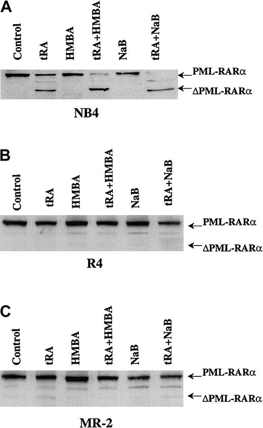 Fig. 4. Western blot analysis of PML-RARα cleavage in NB4 and R4 cells treated by tRA combined with HMBA or NaB. / The cells were treated with 10−7 μM tRA, 2 mM HMBA, and 0.5 mM NaB, alone or in combination as labeled, for 3 days. Anti-RARα antibody was used to detect PML-RARα and ΔPML-RARα.