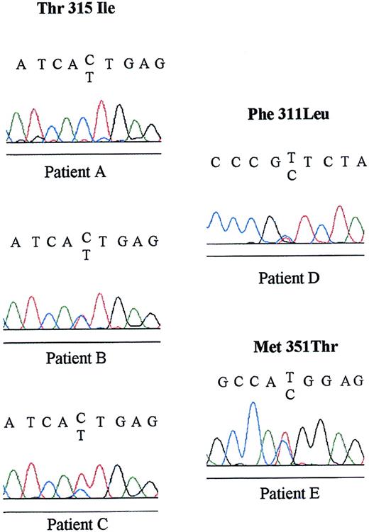 Fig. 2. Primary sequence data of Thr315Ile, Phe311Leu, and Met351Thr ABL mutations. / Primary sequence data of the 5 mutated patients of our study are presented with the corresponding sequence. Upper reading frame: wild-type sequence. Lower reading frame: mutated sequence. Black indicates guanine (G); blue, cytosine (C); red, thymydine (T); and green, adenosine (A).