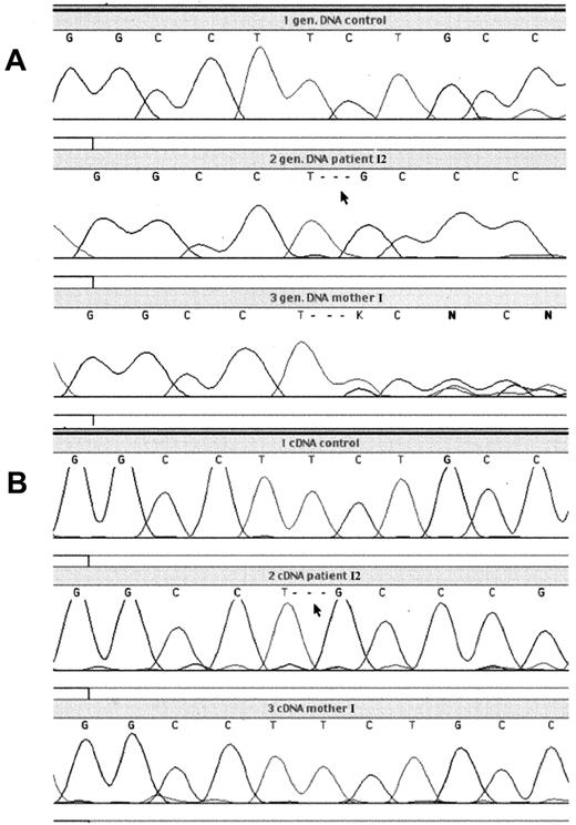 Fig. 1. Analysis of genomic and cDNA from patient I2 with G6PD Amsterdam and his mother. / PCR product, containing the region around the nucleotide 180-182 deletion, was generated from genomic DNA or cDNA obtained from blood leukocytes and was analyzed by dye primer cycle sequencing. (A) Genomic DNA from the leukocytes of a healthy control, patient I2, and his mother; (B) cDNA from the leukocytes of a healthy control, patient I2, and his mother.