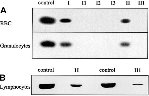 Fig. 2. G6PD protein expression in purified blood cells. / (A) Western blot analysis of G6PD protein expression in RBCs and granulocytes of the patients suffering from G6PD Amsterdam and their mothers. (B). Western blot analysis of G6PD protein expression in PHA-stimulated lymphocytes of patient II1 and his mother, mother II. For all Western blots, cells from a healthy donor were taken as a control.