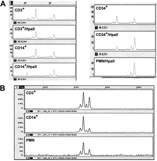 Fig. 6. Representative example demonstrating clonality in various subpopulations of cells in patients with MDS. / (A) LOH (D5S471). (B) X-chromosome activation. Two peaks represent the 2 alleles. Loss of one peak (or significant reduction in its intensity) represents a loss of an allele. In the X-chromosome analysis, clonality is present when one peak disappears after digestion with the restriction enzyme Hpa1 because of lack of amplification products caused by the enzymatic digestion.