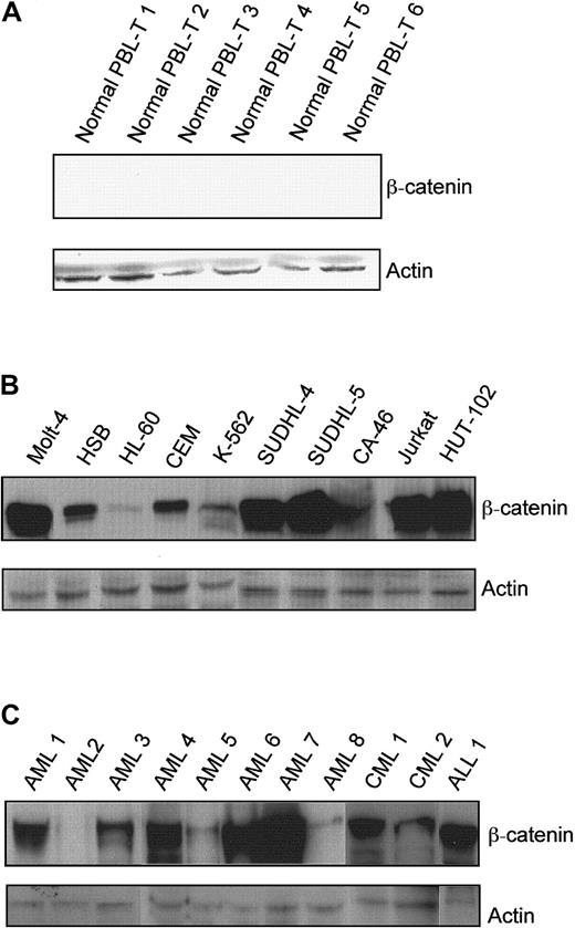 Fig. 1. β-Catenin protein levels in normal peripheral blood T cells, leukemia/lymphoma cell lines, and primary leukemia cells. / (A) Peripheral blood obtained from healthy volunteers was separated on Ficoll gradients, and the mononuclear cells were depleted of monocytes by brief incubation on plastic. T cells were enriched by removal of natural killer cells and B cells using Dynal beads coated with anti-CD16 and anti-CD19 antibodies, respectively. β-Catenin and actin protein levels in the resulting populations were measured by Western blot analysis. (B) β-Catenin and actin in total cell lysates from leukemia/lymphoma cell lines were determined by Western blot analysis with chemiluminescence detection. (C) β-Catenin and actin in total cell lysates from primary leukemia cells were determined. (Lane 1, AML-M4, newly diagnosed; lane 2, AML-M2, newly diagnosed; lane 3, AML-M5, newly diagnosed; lane 4, AML-M4, refractory; lane 5, AML-M5, refractory; lane 6, AML-M5, newly diagnosed; lane 7, AML-M0, newly diagnosed; lane 8, AML-M3, newly diagnosed; lane 9, CML blast crisis; lane 10, CML, chronic phase; lane 11, relapsed T-ALL).