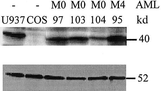Fig. 2. PU.1 mutant proteins are expressed in leukemic cells. / Whole cell lysates from leukemic cells at diagnosis were analyzed by Western blot for PU.1 expression (upper panel). U937 cells served as a positive control, whereas COS cells were negative for PU.1 expression. AML patients #97 and #103 had an AML-M0 subtype and lacked PU.1 mutations. In contrast, AML-M0 patient #104 carries the heterozygous V105-H264del mutation that encodes a mutant peptide lacking the PEST and Ets domains. This peptide is detected by an amino-terminal PU.1 antibody19 (data not shown), not by the antibody used in this blot, which is raised against a carboxyl terminal epitope deleted in the mutant allele. The peptide detected in patient #104 is that encoded by the wild-type allele, and approximately one-half as much protein is detected as compared to the other samples. Patient #95 is an AML-M4 with no PU.1 mutation. (Lower panel) The same blot was stained for β-tubulin as a loading control. The comparative amount of PU.1 protein was assessed by quantitation on a phosphorimager (Molecular Dynamics) and normalized to β-tubulin.