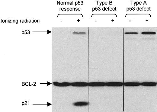 Fig. 1. Detection of p53 dysfunction by Western blotting. / CLL cells were analyzed for p53 and p21 expression 10 to 18 hours after exposure to ionizing radiation (5 Gy). BCL-2 was used as a control for protein loading. Type A p53 dysfunction (due to TP53mutation) is characterized by increased baseline levels of p53 and impaired radiation-induced up-regulation of p21. Type B p53 dysfunction (due to ATM mutation) is characterized by impaired up-regulation of both p53 and p21.