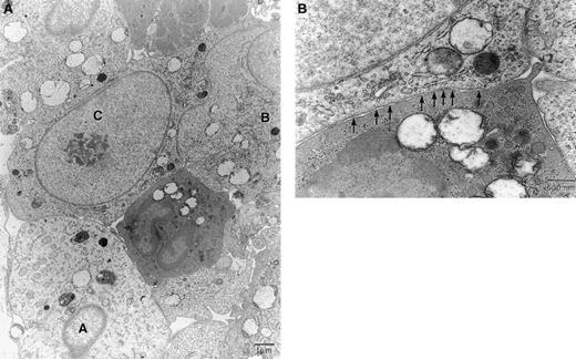 Fig. 5. Electron micrographs examined of the T9-C2 cells after 4 hours' subcutaneous implantation. / Five million T9-C2 cells were injected in a subcutaneous site for 4 hours. Panel A shows 3 tumor cells, labeled A, B, and C, in various stages of swelling and death. Panel B shows a higher magnification of the central granulocyte and cell C. The arrows indicate clathrin-coated pits in cell C. Panels stained with uranyl acetate and osmium tetroxide. Original magnifications: Panel A, × 3100; Panel B, × 12 500.