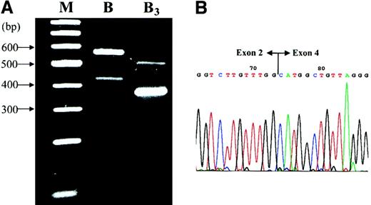 Fig. 3. ABO transcript structures of the group B individual and the B3 individual with the IVS3 + 5G → A mutation analyzed by RT-PCR. / (A) RT-PCR results obtained from the RNA samples of the group B individual and the B3 individual with the IVS3 + 5G → A mutation. The RT-PCR products were analyzed by 3.0% agarose gel electrophoresis. The results obtained from the common B and the B3 samples are shown in lane B and lane B3, respectively. Lane M shows the molecular mass standards of the 100-bp ladder. The 2 products (559 and 424 bp) from the group B sample were demonstrated to be amplified from the complete BcDNA structure and from the B cDNA structure without the exon 6 region, respectively. The 2 smaller products (502 and 367 bp) from the B3 sample were shown to be amplified, respectively, from the B cDNA with exon 3 skipped and from the B cDNA with exon 3 and exon 6 skipped. (B) Sequencing result of the 502-bp product obtained from the B3 RNA sample. The 502-bp fragment obtained from the B3 RNA sample was eluted from the agarose gel and sequenced. It was demonstrated to have the exon 2–exon 7 structure but without the exon 3 region. The linkage of exon 2 and exon 4, indicating the skipping of exon 3, is shown.