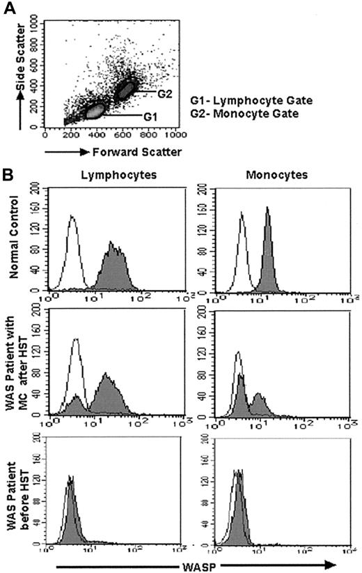 Fig. 1. Results of FCM-WASP of lymphocytes and monocytes. / (A) Density plot shows forward- and side-scatter data from PBMCs. Lymphocytes (G1 gate) and monocytes (G2 gate) are gated according to the values of these variables. (B) FCM-WASP with a 3-decade log scale. The x-axis represents WASP expression; the y-axis represents cell numbers. The open histogram indicates isotype-control staining; the solid histogram indicates specific staining of WASP. Shown is WASP expression in lymphocytes and monocytes from a healthy control (top), a WAS patient with MC status after HST (middle; data from patient 2 on day 360 after HST), and a WAS patient (patient 12) before HST (bottom).