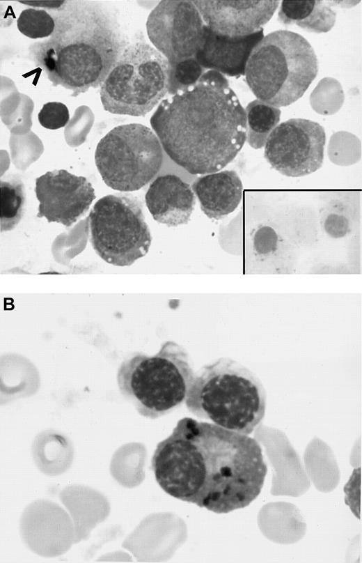 Fig. 1. BM aspirate. / (A) Initial BM smear showing vacuoles in the erythroid precursors, dyspoietic changes, several RSs (inset), and iron granules in plasma cell cytoplasm (arrowhead) (original magnifications, × 890). (B) BM aspirate smears (initial BM aspirate) showing several plasma cells containing blue-black particulate material in the cytoplasm that stained positive with Prussian blue reaction (hemosiderin deposits) (original magnification, × 970).