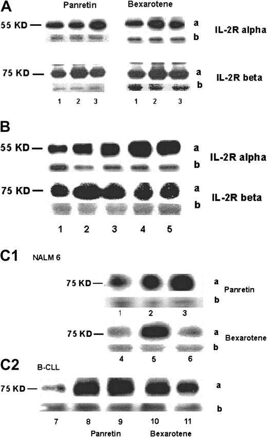 Fig. 2. Intracellular expression of p55 (IL-2Rα) and p75 (IL-2Rβ) proteins. / Cells were treated with 10−6 M or 10−8M alitretinoin (Panretin) or bexarotene for 48 hours. The expression of p55 and p75 was analyzed by immunoblot. (A) Lane 1, untreated HUT78 cells (control); lane 2, 10−10 M rexinoid-treated cells; lane 3, 10−8 M rexinoid-treated cells. (B) Lane 1, untreated fresh Sezary cells; lanes 2-5, Sezary cells after exposure to 10−10 M Panretin (lane 2), 10−8 M Panretin (lane 3), 10−10 M bexarotene (lane 4), 10−8 M bexarotene (lane 5). (C) Expression of p75 in NALM6 (lanes 1-6) and CLL cells (lanes 7-11) after rexinoids; lanes 1, 4, and 7, untreated; lanes 2 and 8, 10−10 M Panretin; lanes 3 and 9, 10−8 M Panretin; lanes 5 and 10, 10−8 M bexarotene; lanes 6 and 11, 10−10 M bexarotene. The “a” represents protein band and the “b” represents the constitutively expressed on Coomassie blue–stained protein bands as a control for protein loading.