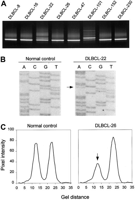 Fig. 1. DGGE-based detection of ATM variants and allelic loss. / (A) DGGE analysis of a region spanning ATM exon 65, showing aberrant bands in samples DLBCL-22 and DLBCL-101. In the latter case, the mutant band is more intense than the wild-type band, suggesting loss of the wild-type allele. (B) Direct sequence analysis of exon 65, showing the R3008H (9023G>A) mutation in DLBCL-22. (C) Detection of anATM deletion in DLBCL-26 as manifested by loss of one of the alleles of the 8850 + 60G/A marker by DGGE analysis. Pixel intensity and gel distance are in arbitrary units.