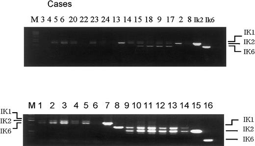 Fig. 1-1. RT-PCR results in pediatric AML and healthy controls. / Upper panel: first-round RT-PCR of AML specimens. Lane number indicates the case number of Table 1 in our article. Of the 7 Ik-6 positive cases, 4 are shown here (case 10 not included, cases 11 and 12 not tested). Lower panel: healthy controls. Lanes 1-8 indicate first-round RT-PCR and lanes 9-16 indicate nested RT-PCR. Template c DNA were obtained from mononuclear cells (lanes 1, 9), CD4+ cells (lanes 2, 10), CD8+ cells (lanes 3, 11), CD14+cells (lanes 4, 12), CD19+ cells (lanes 5, 13), placenta (lanes 6, 14), positive control for Ik2 (lanes 7, 15), and positive control for Ik6 (lanes 8, 16). M indicates Kb ladder marker.