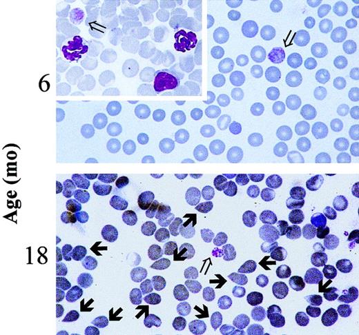 Fig. 1. Presence of tear-drop poikilocytes in the blood of 18-month-old GATA-1low mice. / May-Grünwald-Giemsa staining of representative blood smears obtained from GATA-1low mice at 6 months (upper panel, as negative control) and 18 months (lower panel) of age. Open arrows indicate the dismorphic platelets characteristic of the blood of the Gata-1low mice.1821 Solid arrows indicate the tear-drop poikilocytes that circulated in the blood from these mutants since 15 months of age. Similar results were observed in blood smears from at least 4 to 6 mice. In particular, 18 mice were analyzed in the 12- to 18-month age group. (Original magnification, × 100).