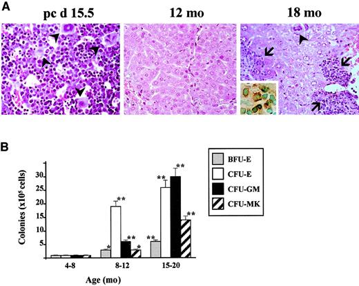Fig. 4. Liver as an extramedullary site of hematopoiesis in old GATA-1low mice. / (A) Hematoxylin-eosin staining of liver sections from a 15-day postcoitum GATA-1low fetus (left panel) or from adult GATA-1low mice at 12 (middle panel) or 18 (right panel) months of age. The inset in the left panel presents CD45 immunohistochemical staining of the liver section immediately following that stained with hematoxylin-eosin. MK are indicated by solid arrowheads and solid nests of hemopoietic cells are indicated by solid arrows. Six mice were independently analyzed in the 12- to 18-month-old age group (original magnification, × 20 for the left panel, × 10 for the middle and right panels, and × 40 for the inset). (B) Frequency of hemopoietic colonies (BFU-E, CFU-E, CFU-GM, and CFU-Mk, as indicated) per 105 liver cells from GATA-1lowmice. Animals were arbitrarily divided into the same age groups used in Table 2. Results are presented as the mean (± SD) of 3 independent experiments for a total of at least 4 mice analyzed per experimental group.