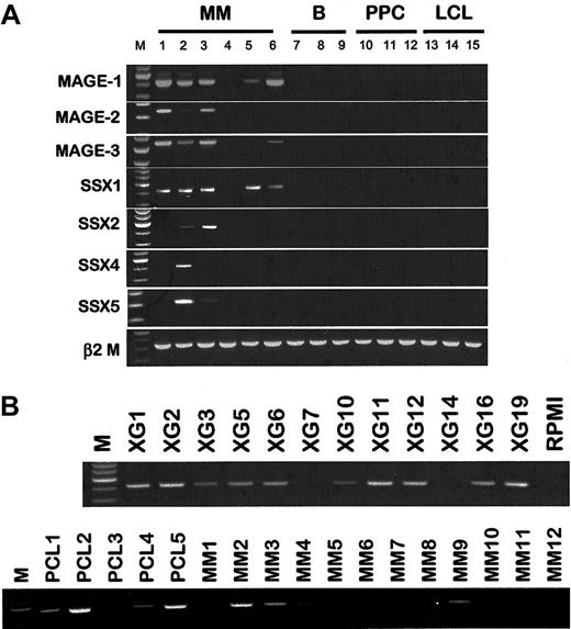 Fig. 8. Expression of cancer-testis genes in PPCs and tumor plasma cells. / (A) RT-PCR analysis of tumor-antigen expression in XG-1 (lane 1), XG-6 (lane 2), XG-16 (lane 3), MM1 (lane 4), MM2 (lane 5), MM3 (lane 6), B1 to B3 (respectively, lanes 7 to 9), PPC1 to PPC3 (respectively, lanes 10 to 12), EBV-1 (lane 13), EBV-5 (lane 14), and EBV-16 (lane 15). (B) RT-PCR for SSX1 on a panel of 13 HMCLs, 5 plasma cell leukemias, and 12 purified myeloma samples at diagnosis.