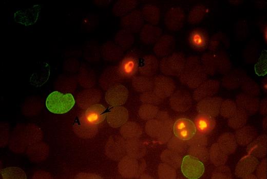 Fig. 1. Fluorescence staining of the blood group antigen. / The positive fluorescence staining shows on A+ RBC with abnormal hemoglobin (A) and the negative staining shows on B+ RBC with normal hemoglobin (B). The intracellular parasites were stained by EB (arrow).