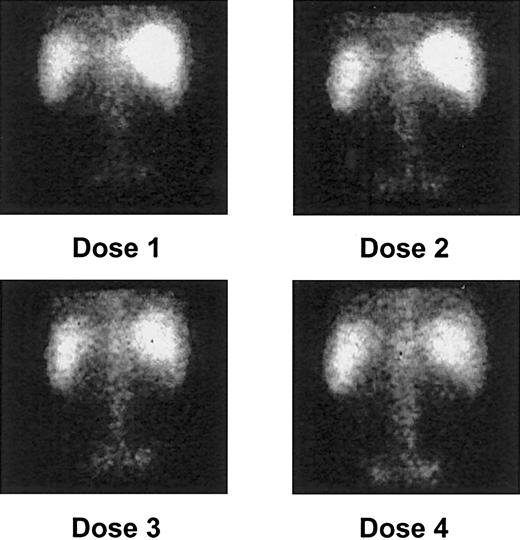 Fig. 1. Posterior gamma camera imaging of patient 2 after each of 4 213Bi-HuM195 injections. / Quantitative targeting of isotope to areas of leukemic involvement, including the bone marrow of the vertebrae and pelvis, the liver, and the spleen, is demonstrated. As noted in most patients, there is a progressive increase in bone marrow uptake of the isotope after each dose.
